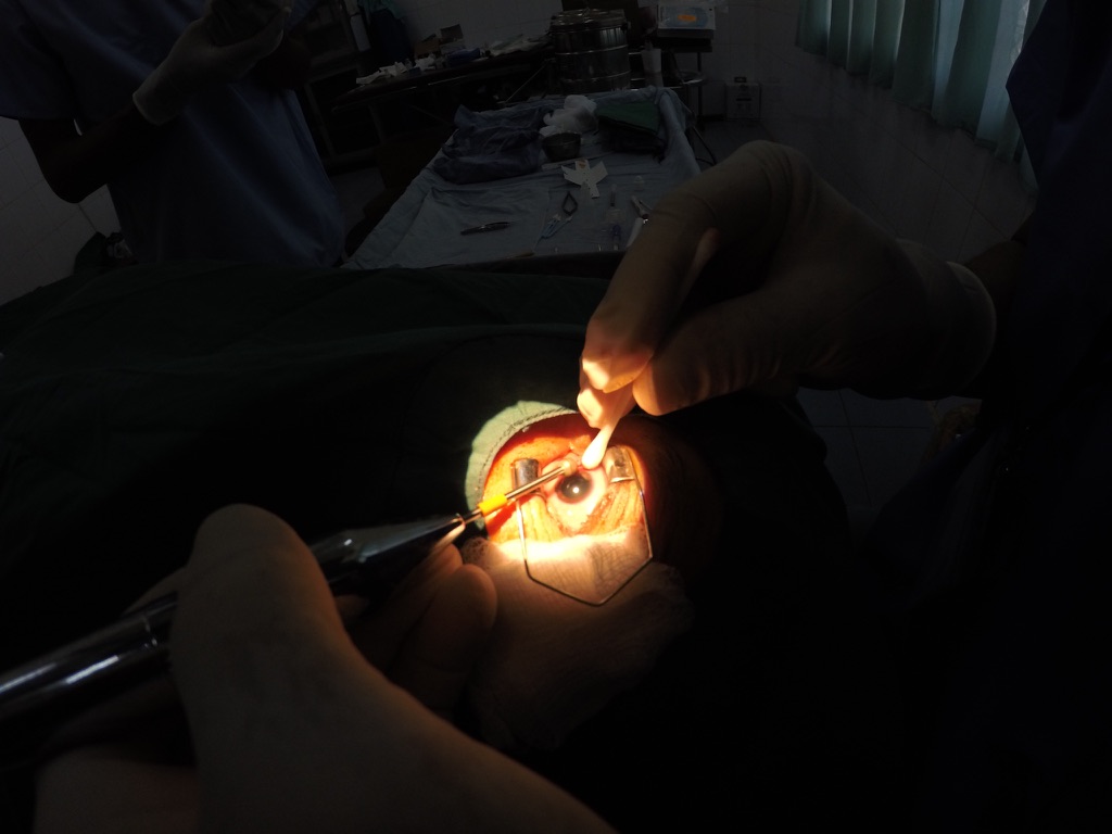 Gloved hands perform eye surgery under a bright surgical light